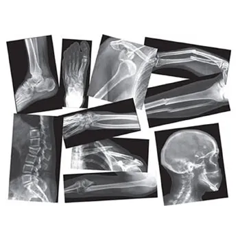 Broken Bones X-Rays - 15 sheets - Modern Teaching Aids NZ